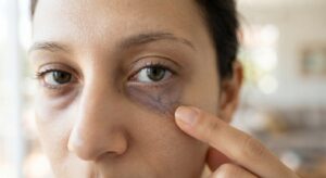 Which of the Four Types of Dark Circles Do You Have?
